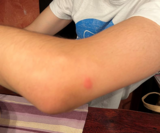 Arm einer Person mit einem Mückenstich. Symbolbild für das Thema Insektenstiche