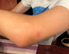 Arm einer Person mit einem Mückenstich. Symbolbild für das Thema Insektenstiche